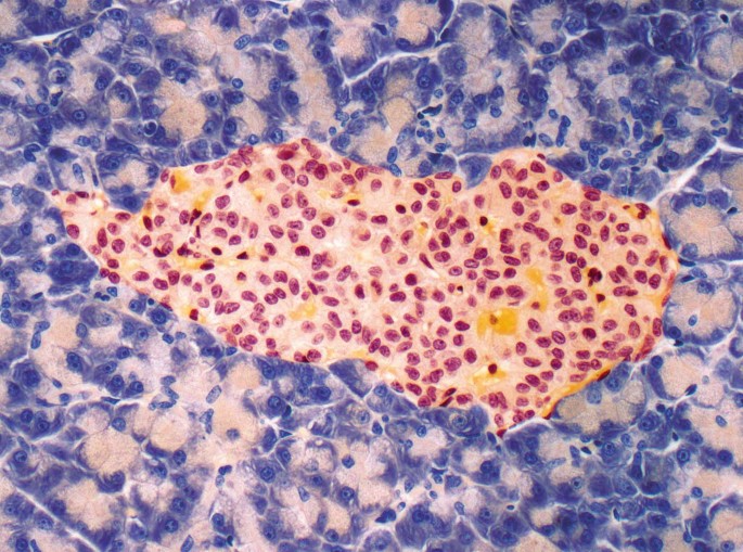 The reconstructed natural history of type 1 diabetes mellitus