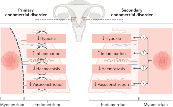 Premenstrual Spotting Found to be Predictive of Endometriosis