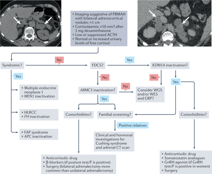 Primary bilateral macronodular adrenal hyperplasia: definitely a genetic disease