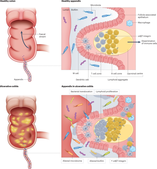 The appendix and ulcerative colitis — an unsolved connection