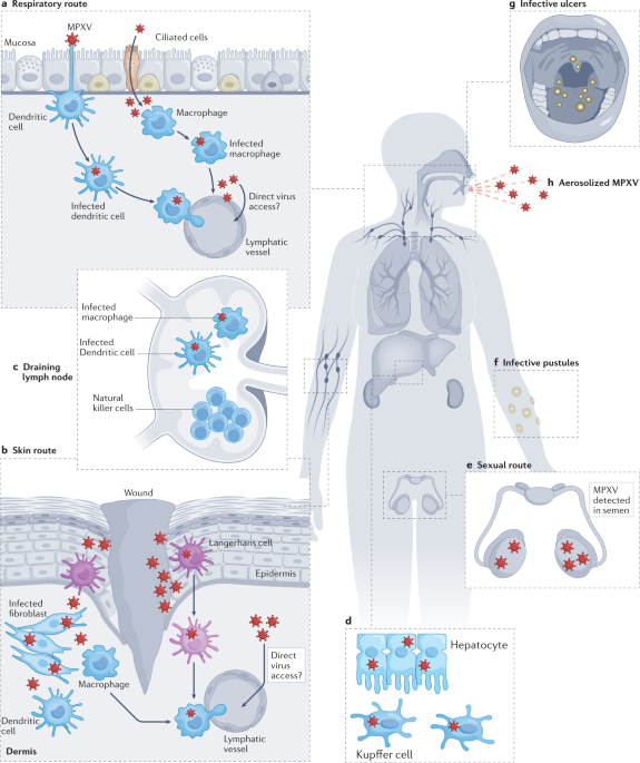 Novel severe oculocutaneous manifestations of human monkeypox virus  infection and their historical analogues - The Lancet Infectious Diseases