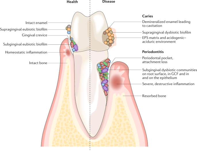 Figura 3- carie e parodontiti