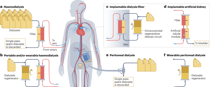 Portable, wearable and implantable artificial kidney systems 