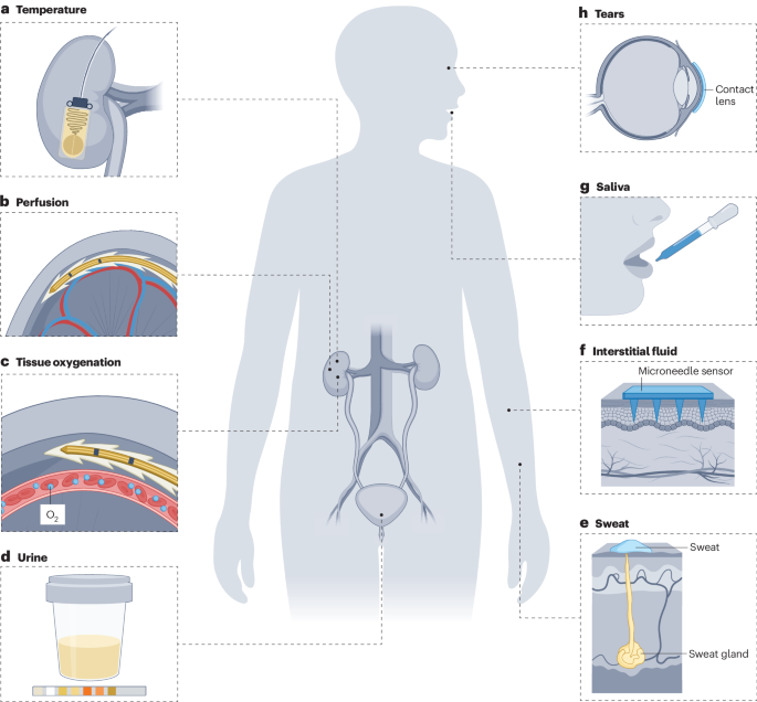 Implantable bioelectronics and wearable sensors for kidney health and disease Implantable bioelectronics and wearable sensors for kidney health and disease