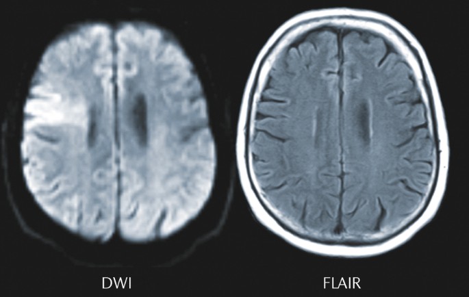 Positive trials in ischaemic stroke reported at ESOC 2018