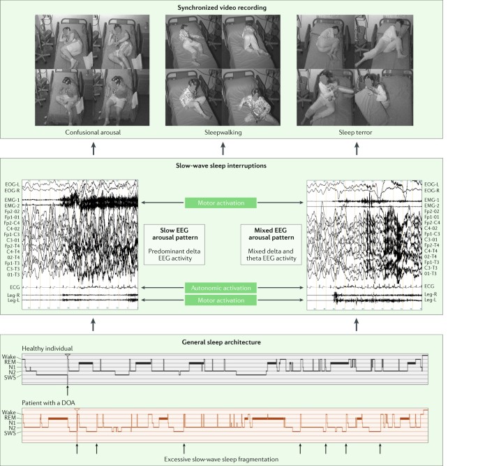 Nrem sleep parasomnias as disorders of sleep-state dissociation