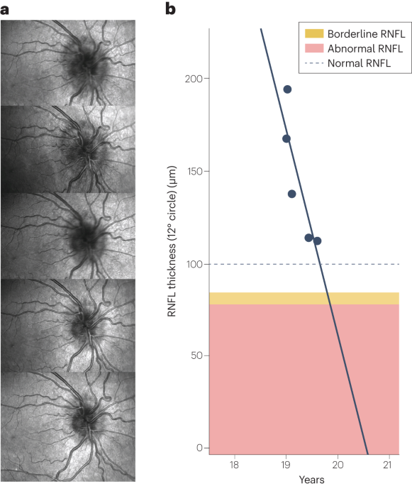 semaglutide intracranial hypertension Idiopathic intracranial hypertension: a step change in understanding the  disease mechanisms