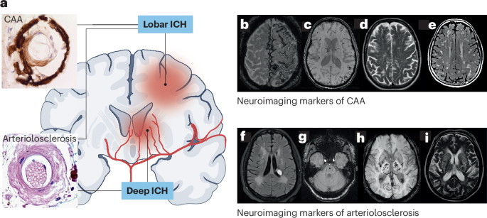 Intracerebral haemorrhage — mechanisms, diagnosis and prospects for treatment and prevention - Nature Reviews Neurology