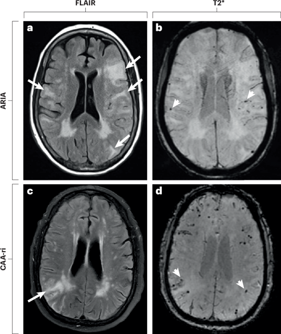 Amyloid-related imaging abnormalities: manifestations, metrics and ...