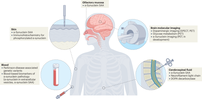 Towards biomarker-based diagnosis of Parkinson disease - Nature Reviews Neurology