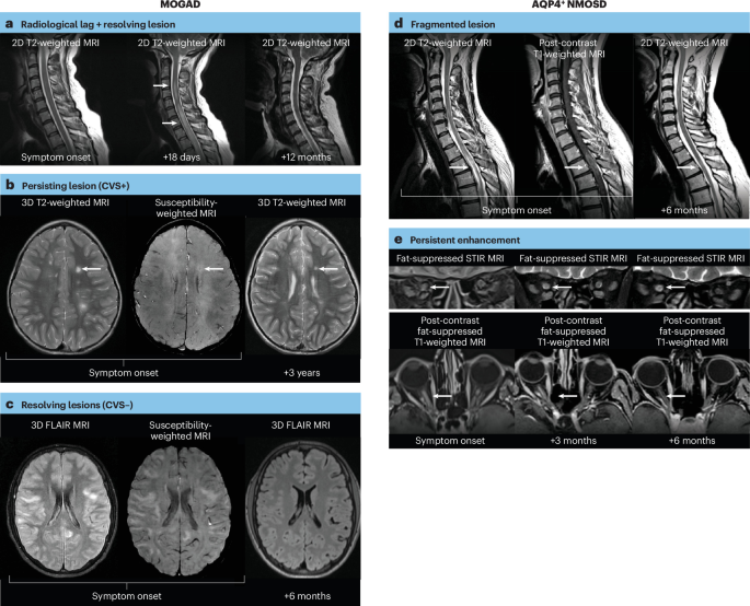 Use of MRI in neuromyelitis optica spectrum disorder and myelin oligodendrocyte glycoprotein antibody-associated disease — MAGNIMS consensus recommendations