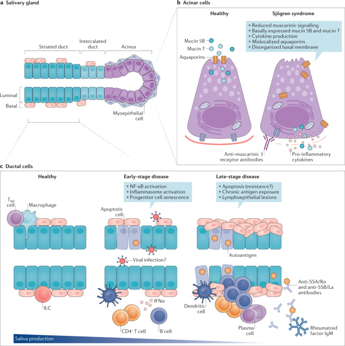 Epithelial–immune cell interplay in primary Sjögren syndrome salivary gland  pathogenesis | Nature Reviews Rheumatology