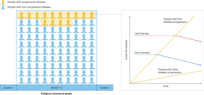 Novel approaches to the stratified management of knee osteoarthritis