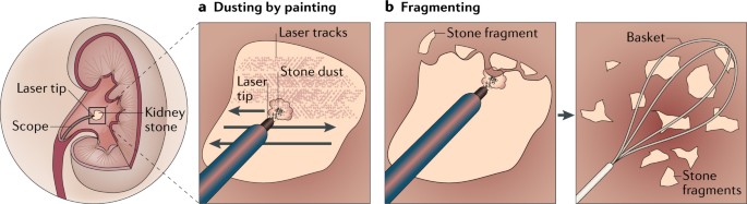 Dusting technique for lithotripsy: what does it mean? | Nature Reviews  Urology