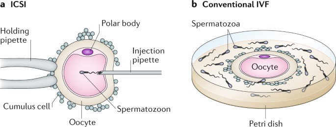 Picture of Intracytoplasmic sperm injection