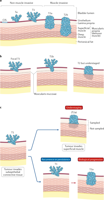 T1 bladder cancer: current considerations for diagnosis ...