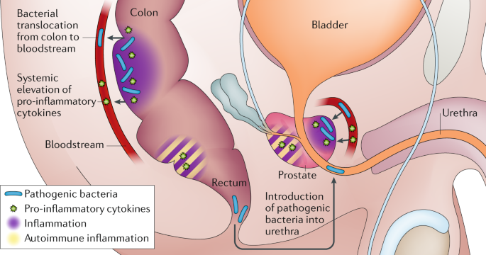 Prostatitis manifeszt Diclofenac gyertya és a prosztata gyulladása