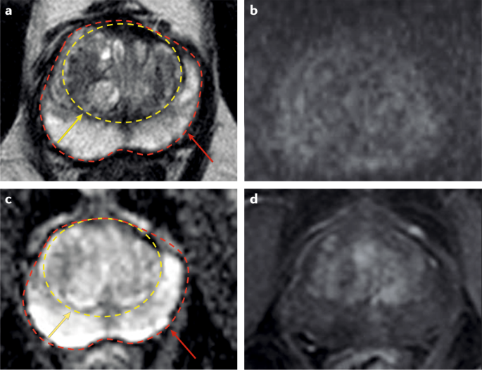 Multiparametric MRI for prostate cancer diagnosis: current status and  future directions | Nature Reviews Urology