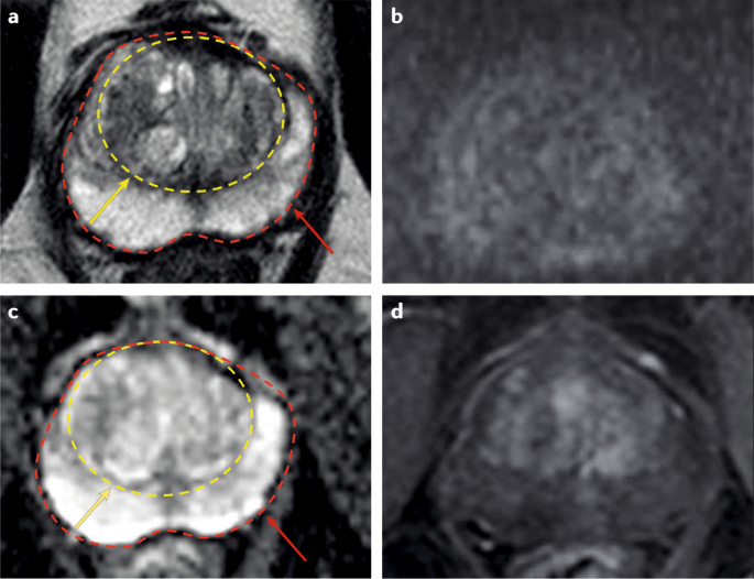 multiparametric prostate mri with contrast