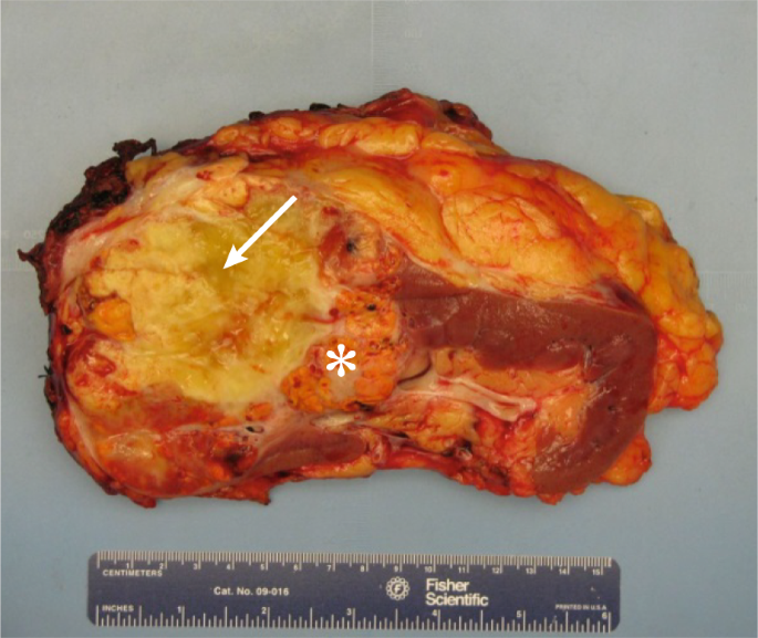 Sarcomatoid Renal Cell Carcinoma: Biology, Natural History And Management |  Nature Reviews Urology