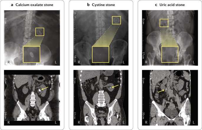 Genetics Of Kidney Stone Disease Nature Reviews Urology