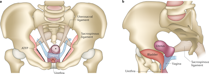 Genito Urinary Prolapse Orthosis - Orthotix
