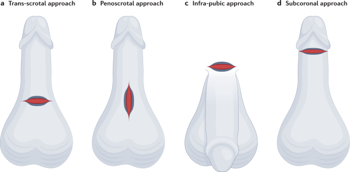 Foreskin Preservation in Penile Surgery