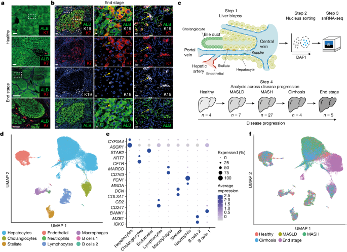 Acquisition of epithelial plasticity in human chronic liver 