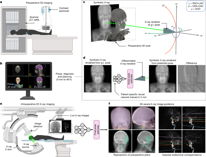Rapid patient-specific neural networks for X-ray to volume registration