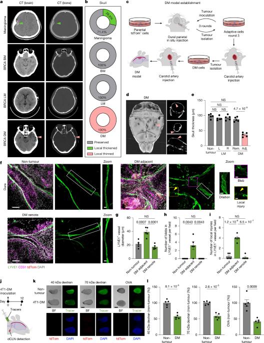 Osteoclasts intercept meningeal lymphatic paths for dural metastasis