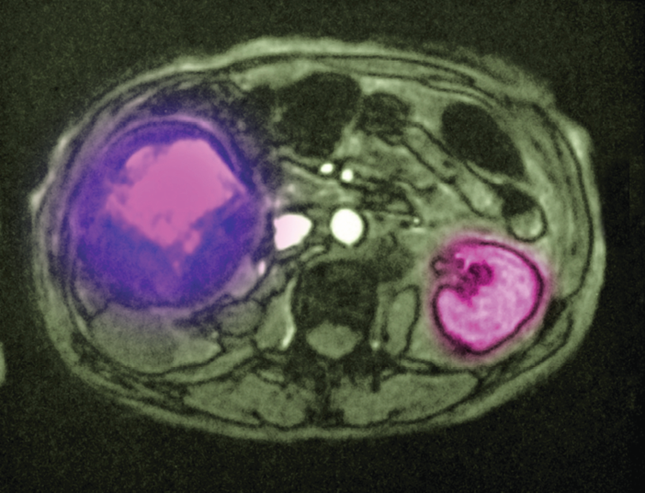 First HIF-2 antagonist for VHL tumors thumbnail