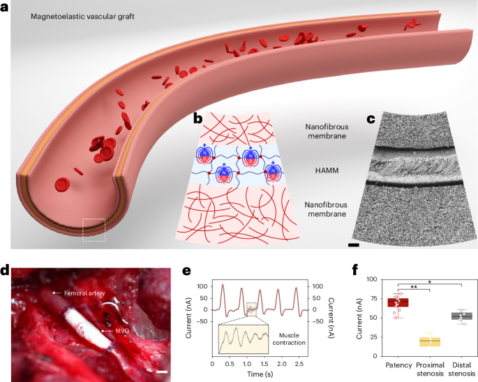 磁気弾性血管グラフトによる自己給電式狭窄診断 – Nature Biotechnology
