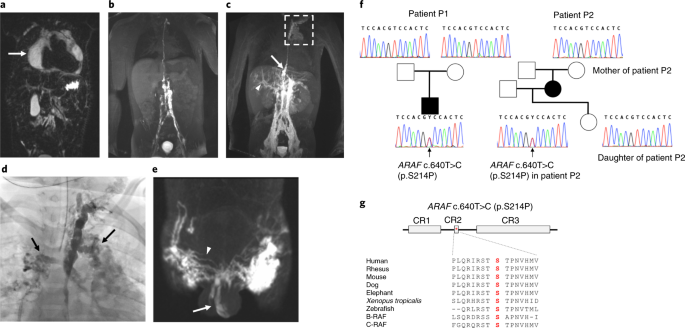 Araf Recurrent Mutation Causes Central Conducting Lymphatic Anomaly Treatable With A Mek Inhibitor Nature Medicine Araf Recurrent Mutation Causes Central Conducting Lymphatic Anomaly Treatable With A Mek Inhibitor Nature Medicine
