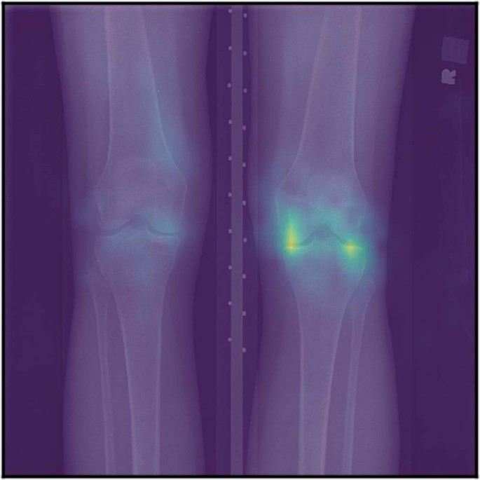 An algorithmic approach to reducing unexplained pain disparities in underserved populations
