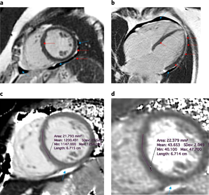 Lingering cardiac involvement in previously well people after mild COVID-19