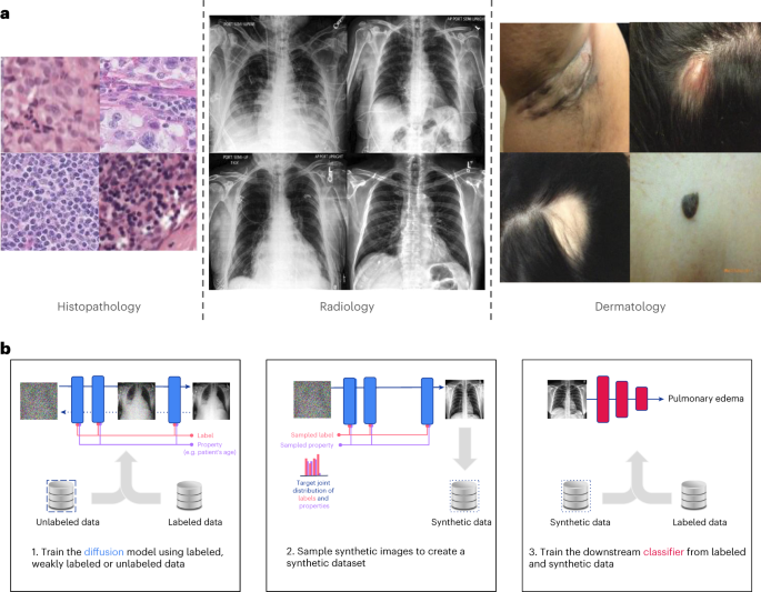 Generative models improve fairness of medical classifiers under 
