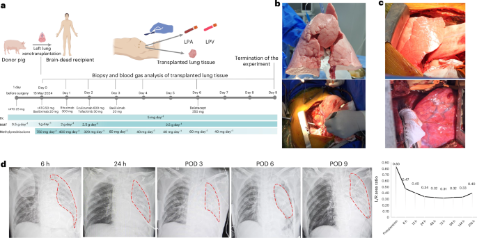 Pig-to-human lung xenotransplantation into a brain-dead recipient - Nature Medicine