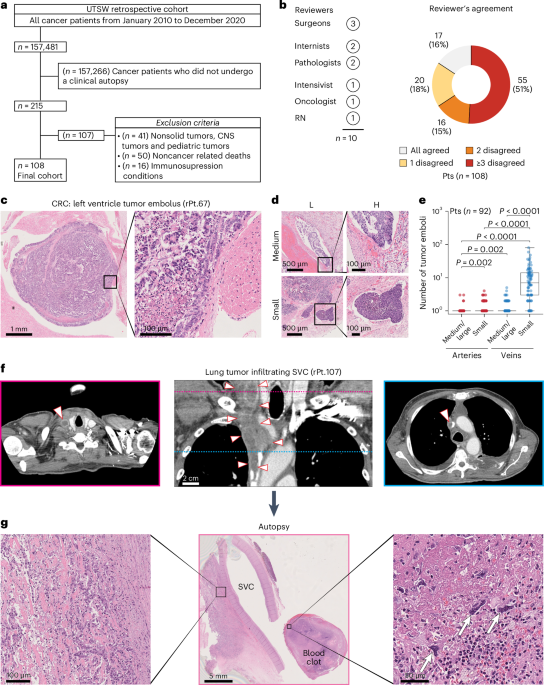 Macrovascular tumor infiltration and tumor cells clusters in cancer patients