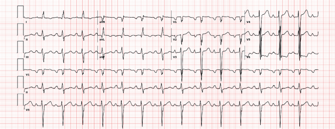 A case of artificial intelligence-enhanced diagnostics leading to heart transplantation