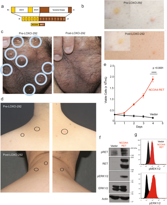 Author Correction: Activating mutations in CSF1R and additional receptor  tyrosine kinases in histiocytic neoplasms | Nature Medicine (via www.nature.com)