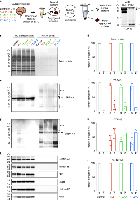 Distinctive Brain Pattern May Underlie >> Tdp 43 Extracted From Frontotemporal Lobar Degeneration Subject Distinctive Brain Pattern May Underlie >> Tdp 43 Extracted From Frontotemporal Lobar Degeneration Subject