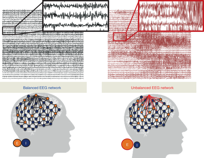 Neural fragility as an EEG marker of the seizure onset zone | Nature  Neuroscience