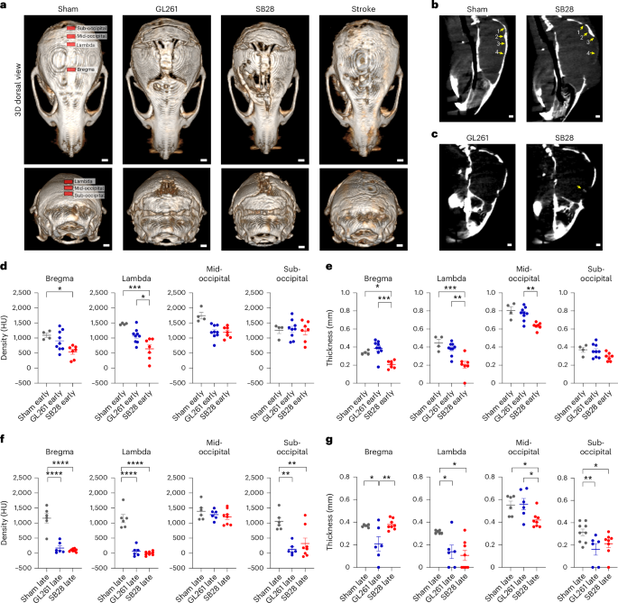 Brain tumors induce disruption of skull bone and alteration of marrow immunity