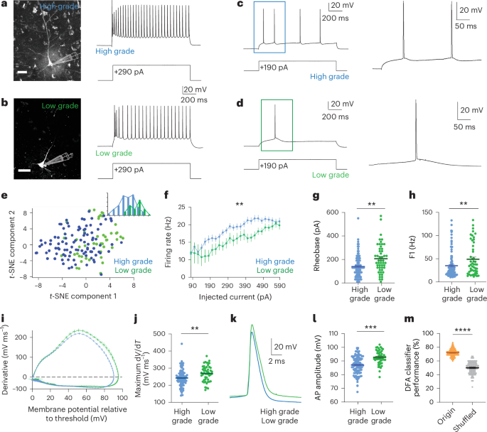 Increased neural excitability and glioma synaptic activity drives glioma proliferation in human cortex