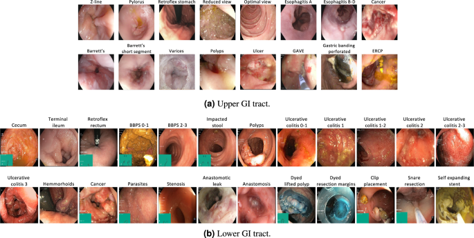 HyperKvasir, a comprehensive multi-class image and video dataset for gastrointestinal endoscopy - Scientific Data