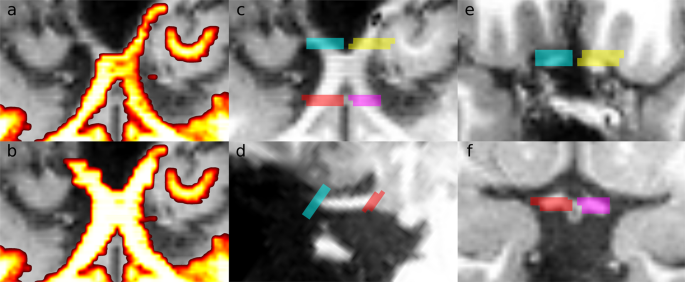 Measuring Connectivity in the Primary Visual Pathway in Human Albinism  Using Diffusion Tensor Imaging and Tractography