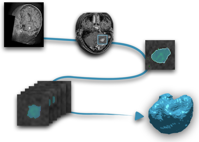A comprehensive dataset of annotated brain metastasis MR images with clinical and radiomic data | Scientific Data A comprehensive... 
