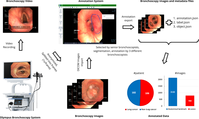 BM-BronchoLC - A rich bronchoscopy dataset for anatomical landmarks and lung cancer lesion recogniti