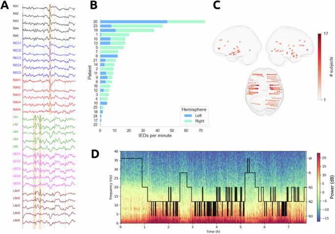 Annotated interictal discharges in intracranial EEG sleep data and ...