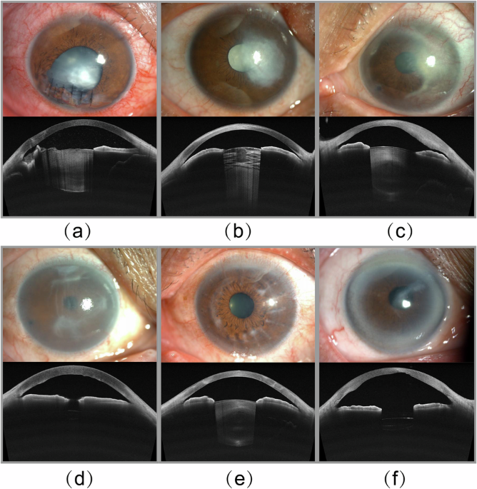 MCOA: A Groundbreaking Dataset for Enhancing Deep Learning in Corneal Opacity Analysis